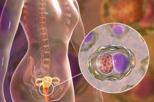 câncer de colo do útero