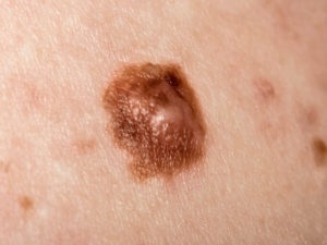 câncer de pele melanoma